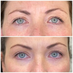 Brow Strengthening and lifting with MONOs alone